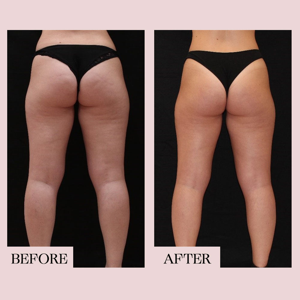 A before and after image of a woman's legs. The image comparison is showcasing the firming effects of a cosmetic cream.