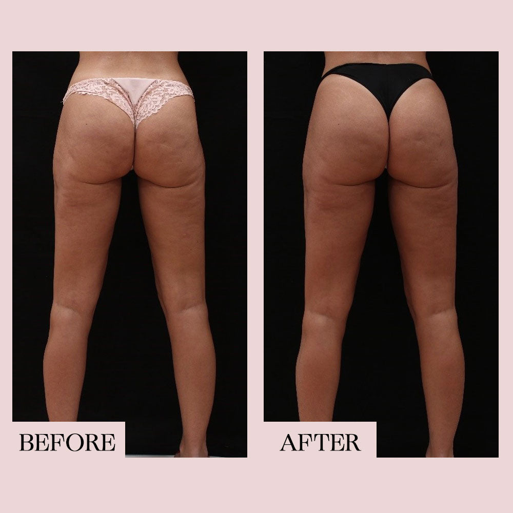 Before and after images of a woman's legs.